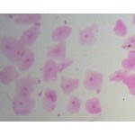 Łuskowaty ludzki nabłonek w postaci wymazu Łuskowaty ludzki nabłonek w postaci wymazu